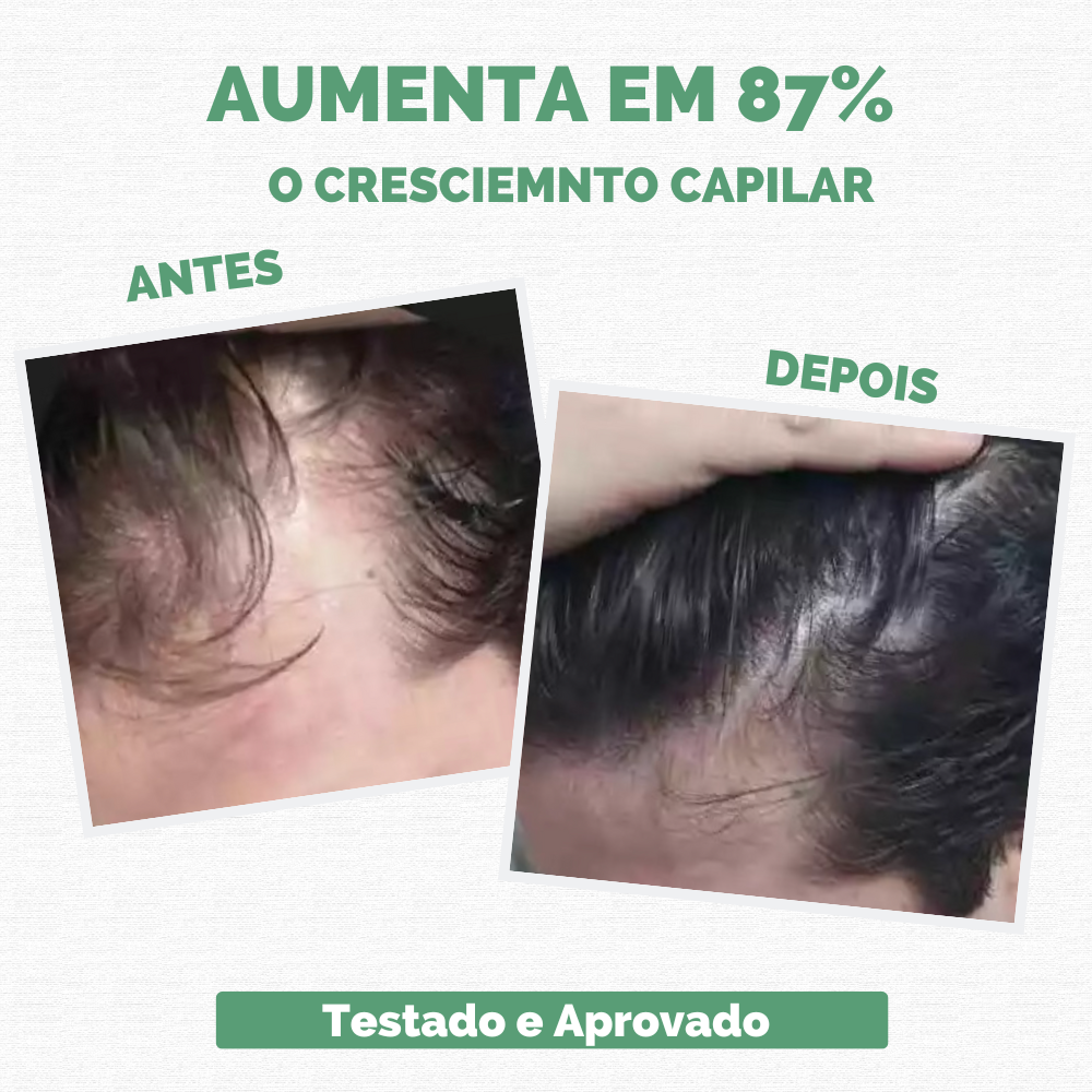 Sérum Repair Hair: Tratamento Revolucionário para Queda de Cabelo